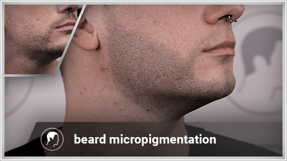 beard micropigmentation right side