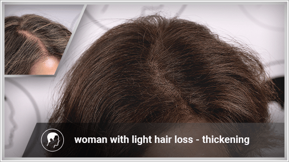 woman with light hair loss - thickening