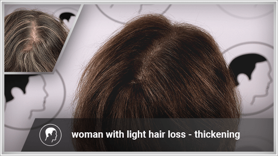 woman with light hair loss - thickening