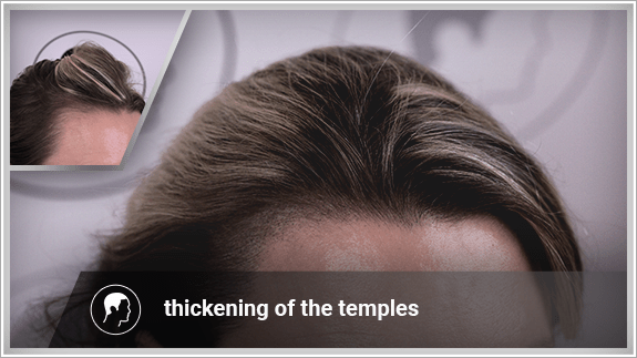 thickening of the temples