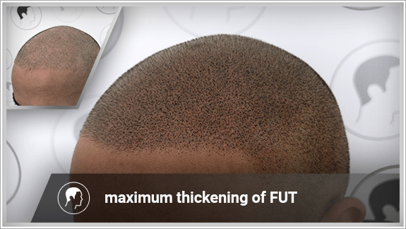 maximum thickening of FUT