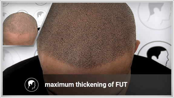 maximum thickening of FUT
