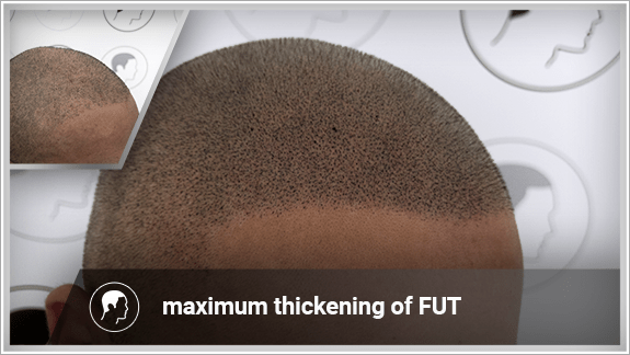 maximum thickening of FUT