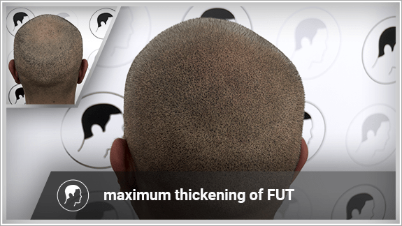 maximum thickening of FUT