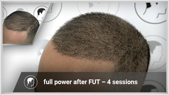 full power after FUT – 4 sessions
