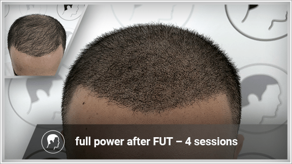 full power after FUT – 4 sessions