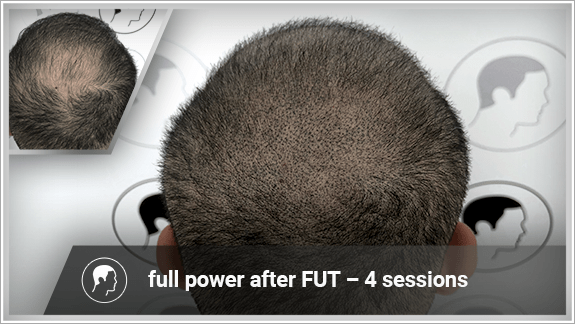 full power after FUT – 4 sessions