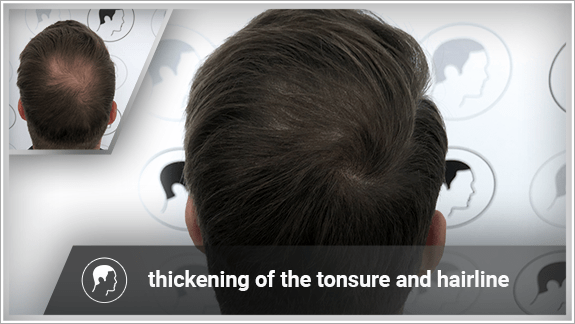 thickening of the tonsure and hairline