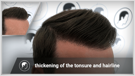 thickening of the tonsure and hairline