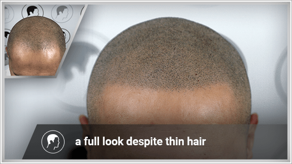 a full look despite thin hair
