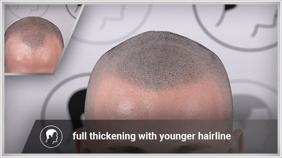 full thickening with younger hairline