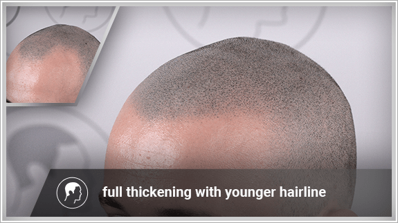 full thickening with younger hairline
