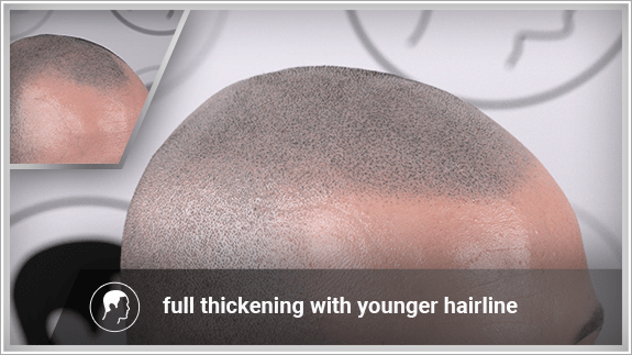 full thickening with younger hairline