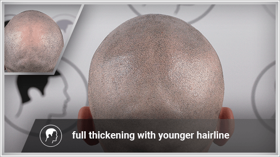 full thickening with younger hairline