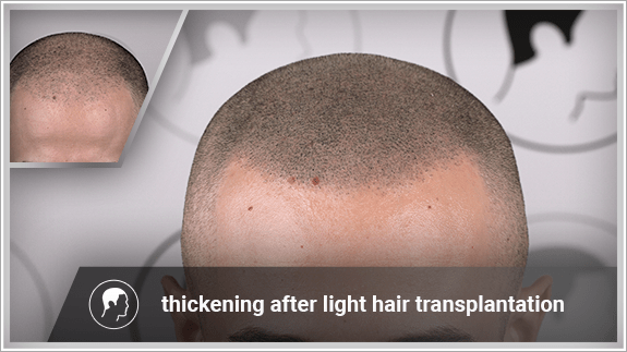 thickening after light hair transplantation