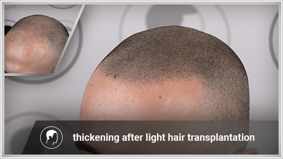 thickening after light hair transplantation