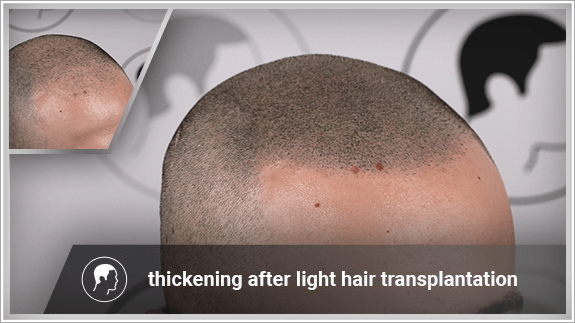 thickening after light hair transplantation