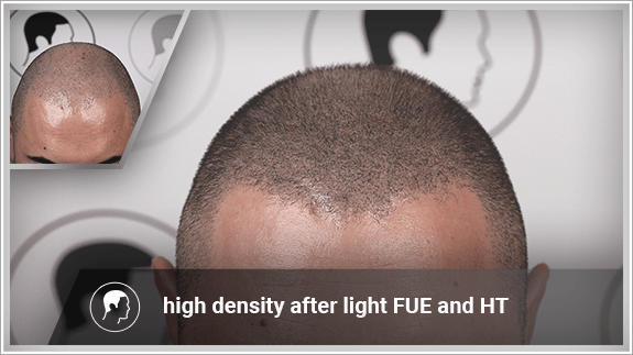 high density after light FUE and HT