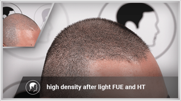 high density after light FUE and HT