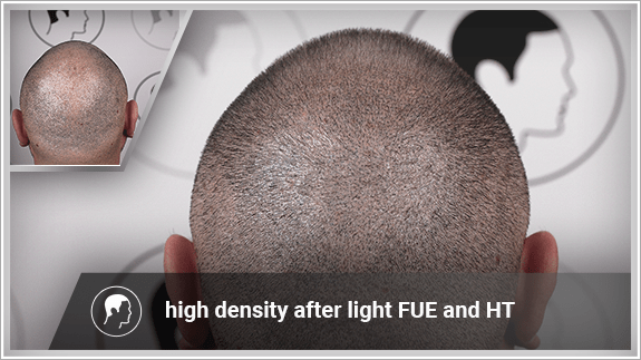 high density after light FUE and HT