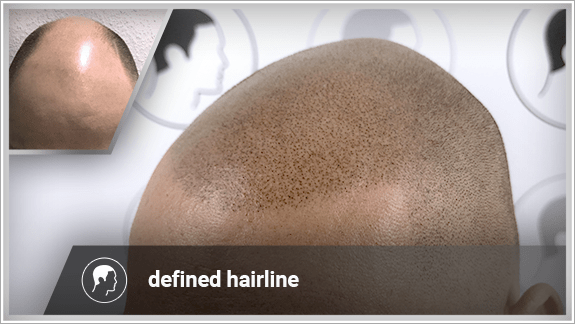 defined hairline