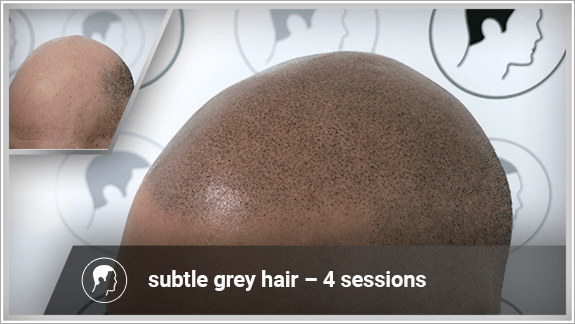 subtle grey hair – 4 sessions