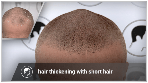 hair thickening with short hair