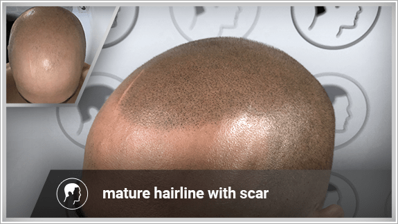 mature hairline with scar