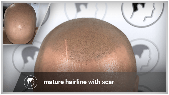 mature hairline with scar