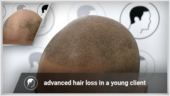advanced hair loss in a young client