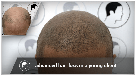 advanced hair loss in a young client