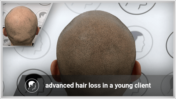 advanced hair loss in a young client