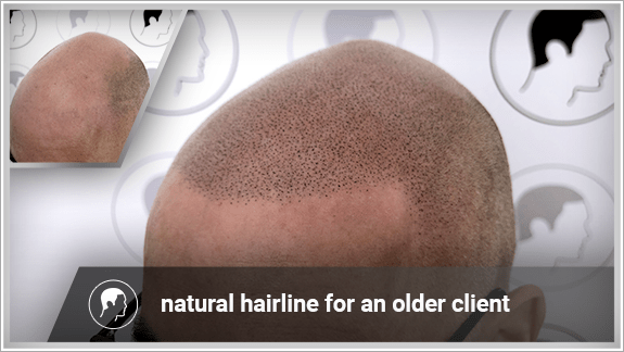 natural hairline for an older client