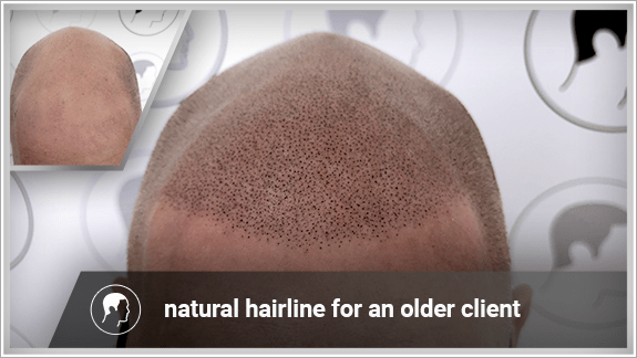 natural hairline for an older client