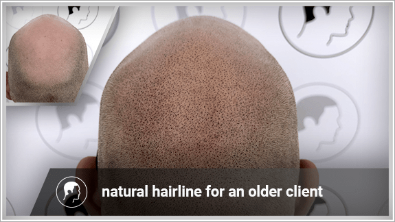 natural hairline for an older client
