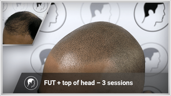 FUT + top of head – 3 sessions