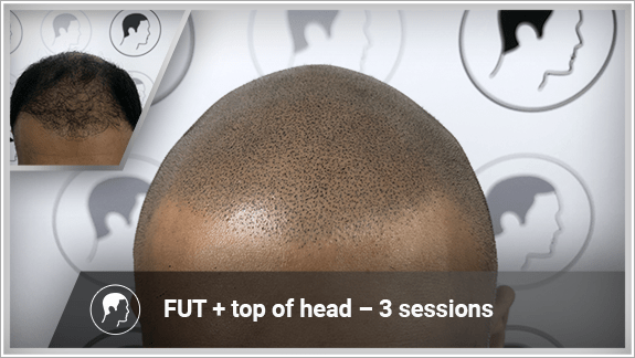 FUT + top of head – 3 sessions