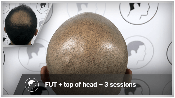 FUT + top of head – 3 sessions