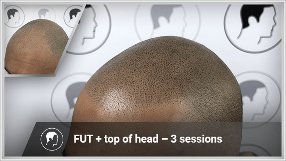 FUT + top of head – 3 sessions