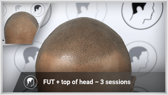 FUT + top of head – 3 sessions