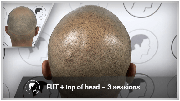 FUT + top of head – 3 sessions