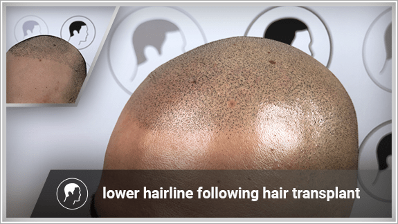 lower hairline following hair transplant