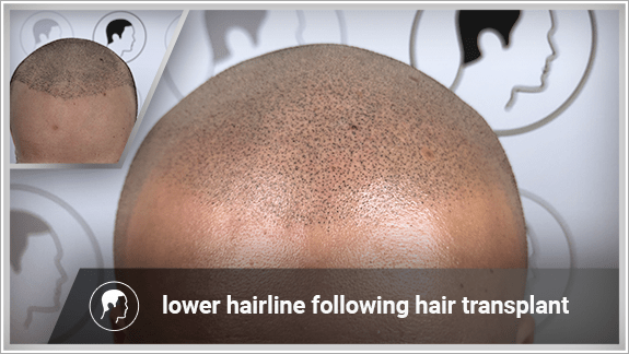 lower hairline following hair transplant