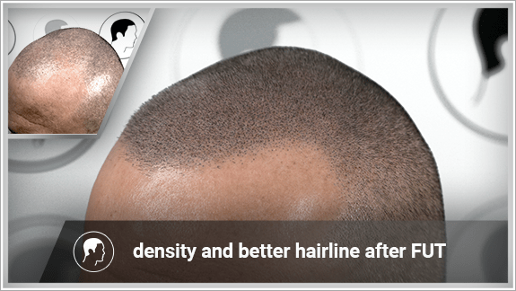 density and better hairline after FUT