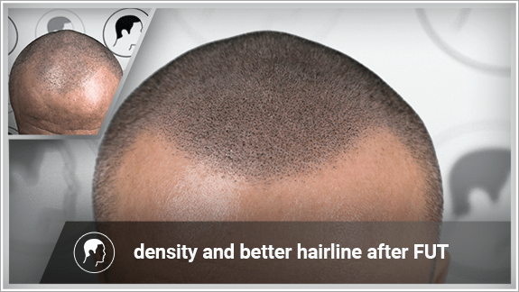 density and better hairline after FUT