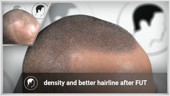 density and better hairline after FUT