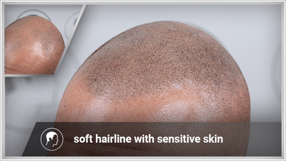soft hairline with sensitive skin