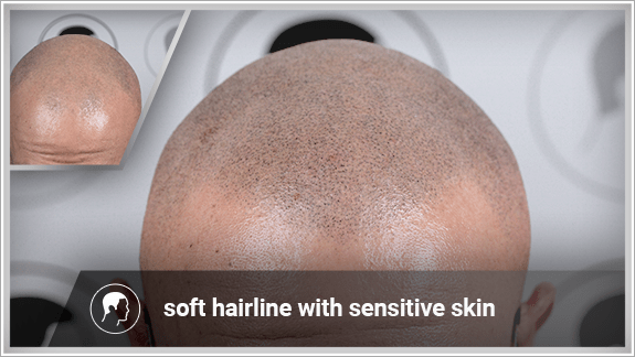 soft hairline with sensitive skin