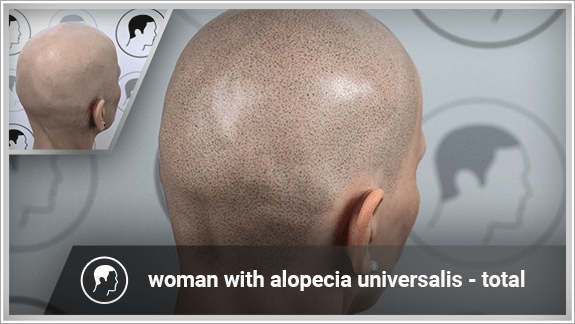Woman with Alopeica Universalis - complete scalp micropigmentation