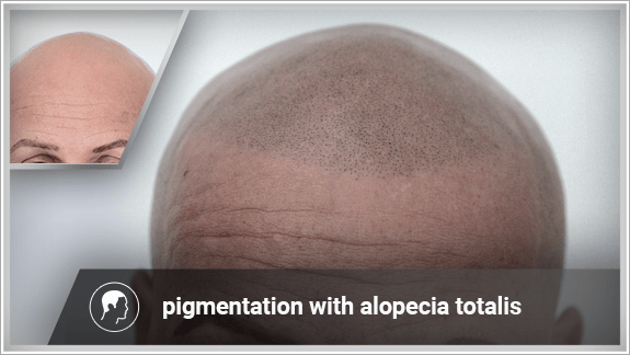 Scalp micropigmentation helps in alopeica totalis